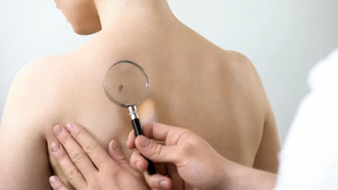 Exhortan a cuidarse del cáncer de piel